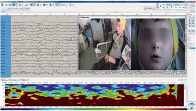 videoeeg module 